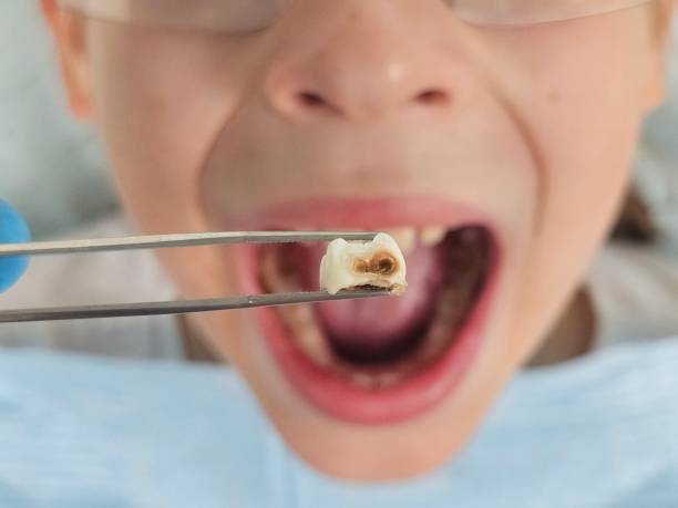 Best Chipped Tooth Repair Near Me  in Monticello, LA